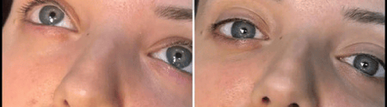 Dermal Fillers